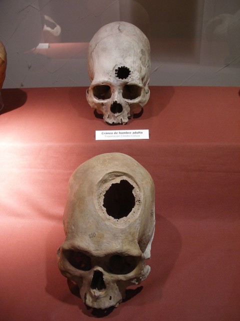 Các hình ảnh ví dụ về phẫu thuật não trong văn hóa Inca từ thế kỷ thứ 15 sau Công nguyên. (Thomas Quine / Wikimedia Commons)
