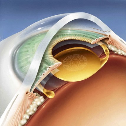 Hình ảnh minh họa Acrysof ReSTOR Lens (màu vàng) được cấy vào mắt người. Ảnh minh họa